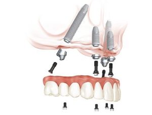 All-on-4® Treatment Concept illustration