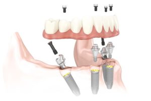 All-on-4® Treatment Concept illustration