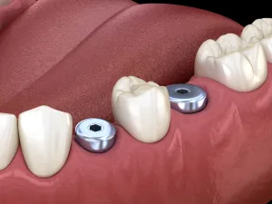 Illustration of dental implants placed in the lower jaw with healing abutments.