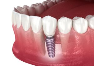 dental implant graphic